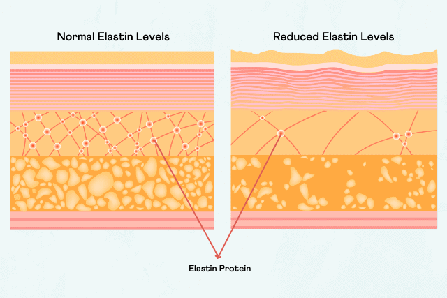 Infographic showing how stretch marks are formed.